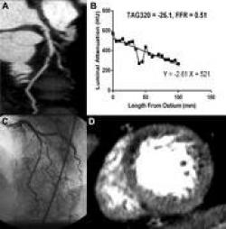 Combining CT stress perfusion and transluminal attenuation gradient to CTA