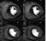 3D MR perfusion compared with scintigraphy for ischemic burden