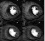 3D MR perfusion compared with scintigraphy for ischemic burden