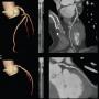 CT coronary angiogram at a dose similar to CXR using model based iterative reconstruction