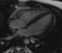 Imaging in assessment of atrial fibrosis in patients with atrial fibrillation