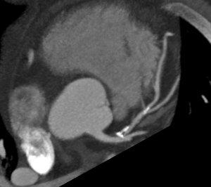 New Multimodality Appropriate Use Criteria for the Detection and Risk Assessment of Stable Ischemic Heart Disease