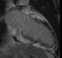 Risk assessment in Myocarditis with cardiac MRI