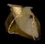 CT coronary angiography in stable angina patients - SCOT-HEART Trial