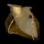 CT coronary angiography in stable angina patients - SCOT-HEART Trial