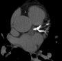 CT coronary artery calcification