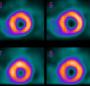 Physiological testing in stable ischemic heart disease, a review of lessons learned