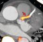 Identification of ruptured and high-risk plaque with 18F-flouride PET-CT