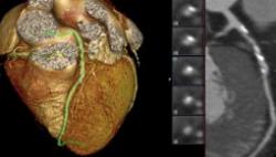 New SCCT guidelines for interpretation and reporting of coronary CT angiography