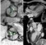 Aortic valve stenosis with MRI: Comparison between high and low gradient and normal and low flow