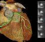 A meta-analysis comparing coronary CT angiography with intra-vascular ultrasound