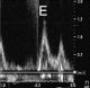 Pre- and post-operative diastolic dysfunction in patients with valvular heart disease